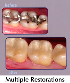 Multiple Restorations - before/after